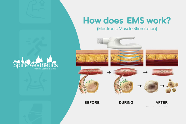 EMS treatment for post pregnancy weight loss treatment Pollokshields