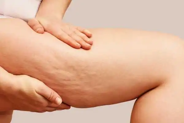 Image of woman showing leg with cellulite Pollokshields