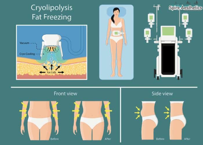 Image of diet and fat freezing combined for best results for Spire Aesthetics Pollokshields