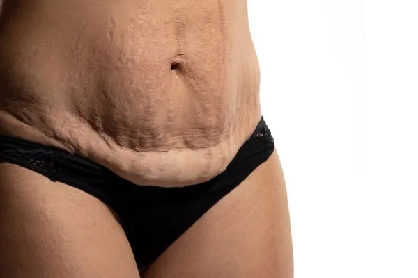 Image of womans stomach after weight loss injections Pollokshields showing saggy skin